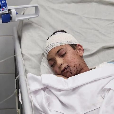 17 طفلًا من غزة يتلقون العلاج في إيطاليا بينهم آدم النجار شقيق 9 شهداء