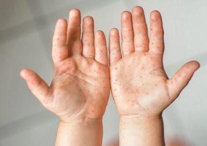 تفشي مرض الحصبة في اسرائيل