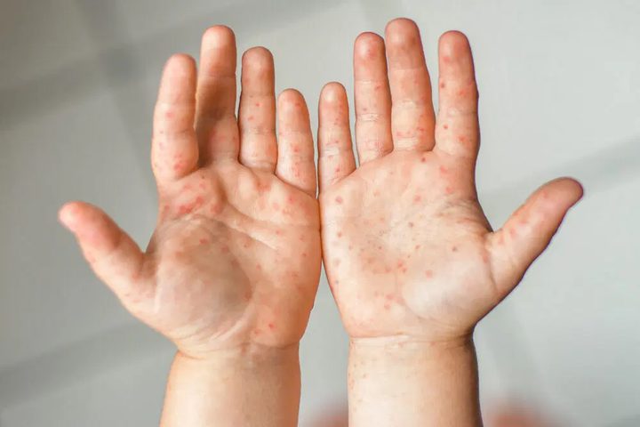 تفشي مرض الحصبة في اسرائيل