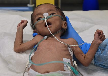 "الأونروا": طفلا من كل 10 أطفال في غزة يخضعون للفحص يعاني من سوء التغذية