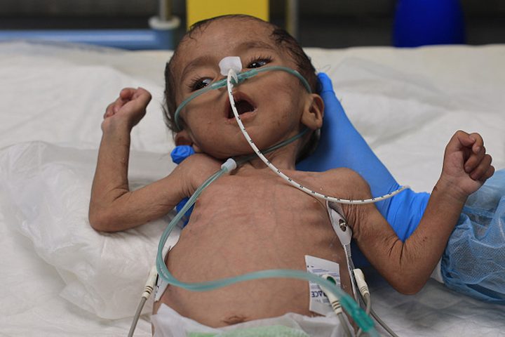 "الأونروا": طفلا من كل 10 أطفال في غزة يخضعون للفحص يعاني من سوء التغذية