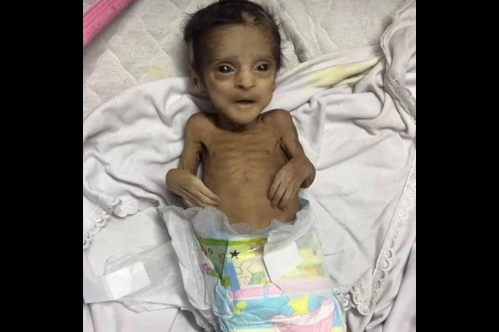 خلال 72 ساعة: 21 طفلا توفوا بسبب سوء التغذية والمجاعة في قطاع غزة