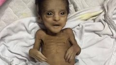 خلال 72 ساعة: 21 طفلا توفوا بسبب سوء التغذية والمجاعة في قطاع غزة