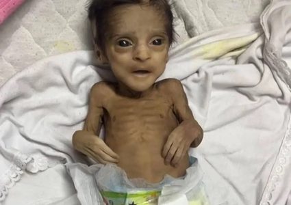 خلال 72 ساعة: 21 طفلا توفوا بسبب سوء التغذية والمجاعة في قطاع غزة