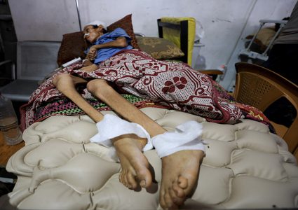 "الشلل الرخو الحاد" يصيب العشرات في غزة.. ما هو؟