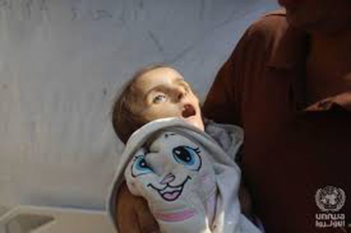 المجاعة تتفاقم .. استشهاد طفل جديد نتيجة الجوع وسوء التغذية