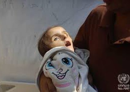 المجاعة تتفاقم .. استشهاد طفل جديد نتيجة الجوع وسوء التغذية