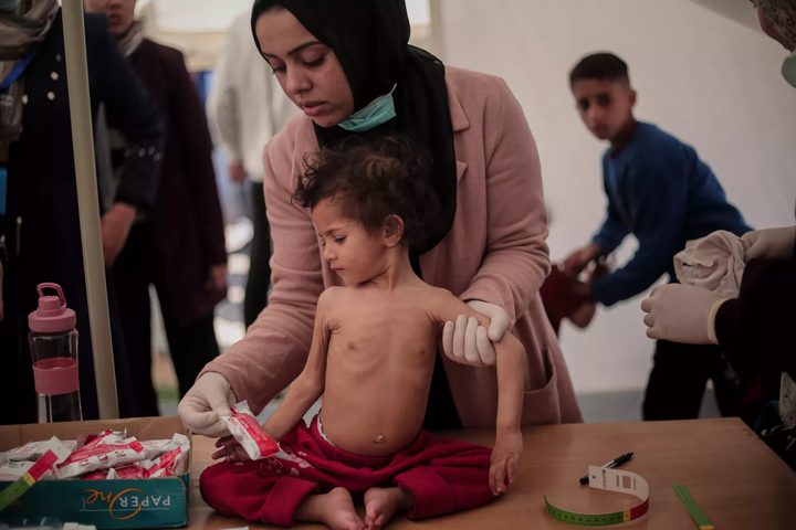 الصحة العالمية:معدلات سوء التغذية في غزة وصلت الى مستويات مقلقة