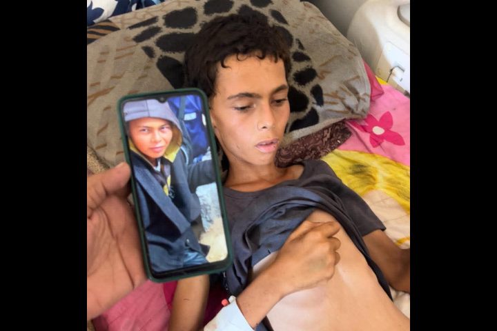 وفاة فتى بسبب سوء التغذية والمجاعة في غزة