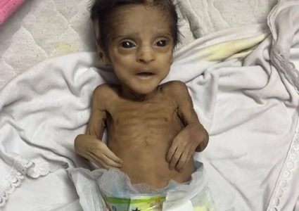 5 وفيات نتيجة المجاعة وسوء التغذية خلال الساعات الـ24 الماضية