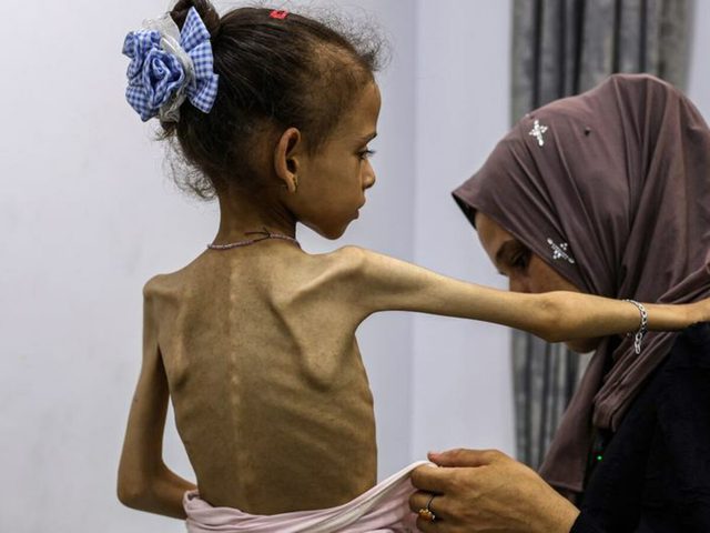8 وفيات نتيجة المجاعة وسوء التغذية خلال الـ24 ساعة الماضية