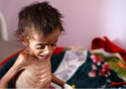 5 حالات وفاة جديدة نتيجة المجاعة وسوء التغذية في قطاع غزة