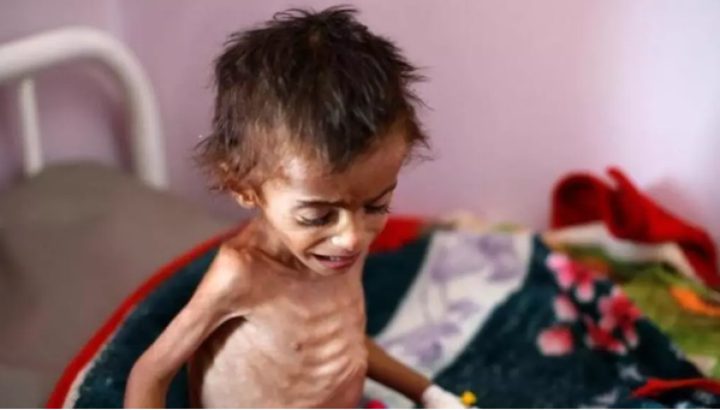 5 حالات وفاة جديدة نتيجة المجاعة وسوء التغذية في قطاع غزة