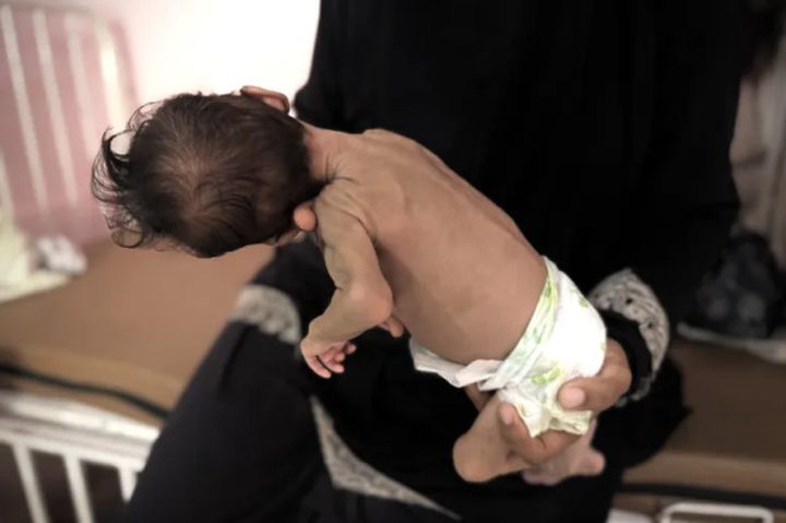 5 وفيات بينهم طفل نتيجة المجاعة وسوء التغذية خلال الساعات الـ24 الماضية