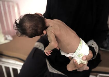 5 وفيات بينهم طفل نتيجة المجاعة وسوء التغذية خلال الساعات الـ24 الماضية