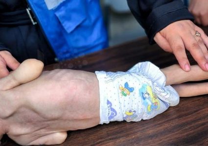 الأمم المتحدة: وفاة أكثر من 100 طفل في غزة بسبب سوء التغذية