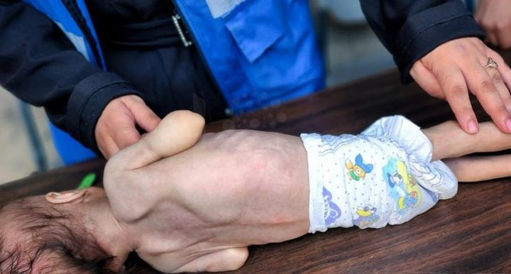 الأمم المتحدة: وفاة أكثر من 100 طفل في غزة بسبب سوء التغذية