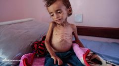 خلال 24 ساعة .. وفاة أربعة مواطنين بسبب سوء التغذية والمجاعة في قطاع غزة