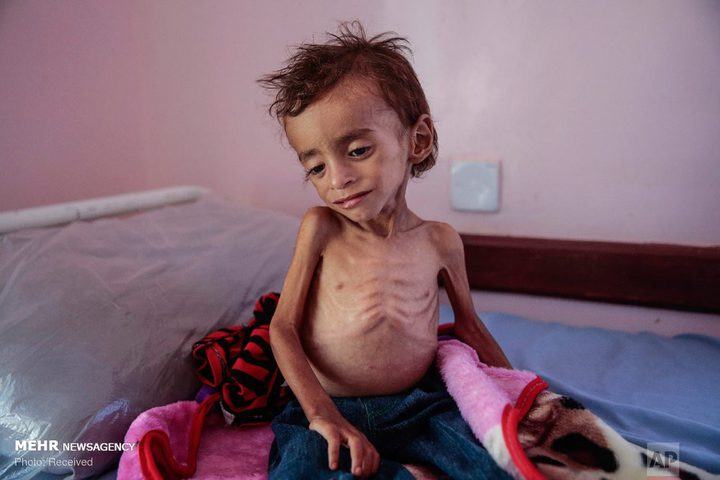 خلال 24 ساعة .. وفاة أربعة مواطنين بسبب سوء التغذية والمجاعة في قطاع غزة