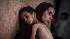 إعلامي غزة: أكثر من 40 ألف رضيع مهددون بالموت بسبب الجوع