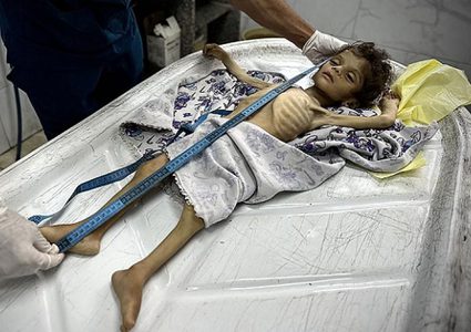 وفاة 5 مواطنين بينهم طفلان خلال الـ24 ساعة الماضية بسبب سوء التغذية والمجاعة