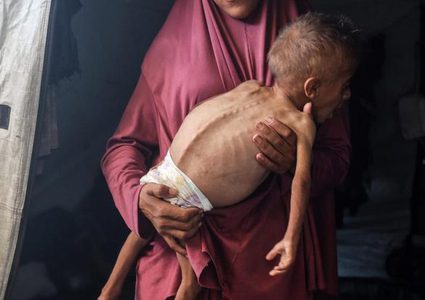 3 وفيات نتيجة المجاعة وسوء التغذية خلال الـ24 ساعة الماضية