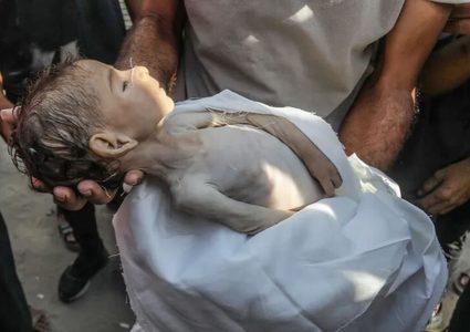 11 وفاة نتيجة المجاعة وسوء التغذية خلال الـ 24 ساعة الماضية