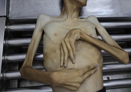 غزة.. 3 وفيات جديدة بالمجاعة ترفع الحصيلة إلى 376 ضحية