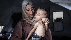 ارتفاع وفيات سوء التغذية في غزة إلى 382 حالة