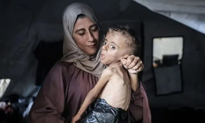 ارتفاع وفيات سوء التغذية في غزة إلى 382 حالة