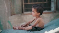 خلال 24 ساعة: 6 شهداء بينهم طفلان جراء المجاعة وسوء التغذية في غزة خلال يوم