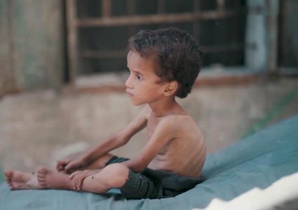 خلال 24 ساعة: 6 شهداء بينهم طفلان جراء المجاعة وسوء التغذية في غزة خلال يوم