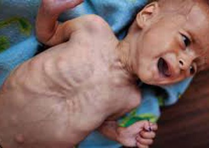 7 حالات وفاة جديدة نتيجة المجاعة لترتفع الحصيلة لـ 420 شهيدا