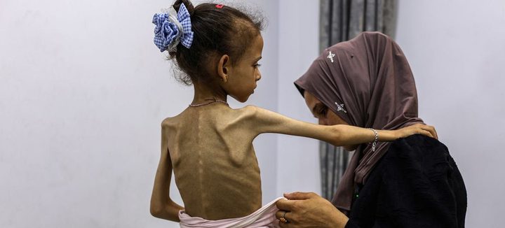 4 وفيات بينهم طفل نتيجة المجاعة وسوء التغذية خلال الـ24 ساعة الماضية