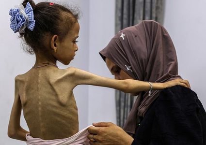 4 وفيات بينهم طفل نتيجة المجاعة وسوء التغذية خلال الـ24 ساعة الماضية