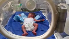 وفاة رضيع وإجلاء 3 خدج من مستشفى الحلو بمدينة غزة إلى جنوب القطاع