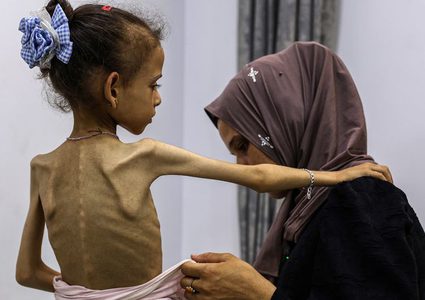 وفاتان نتيجة سوء التغذية في غزة