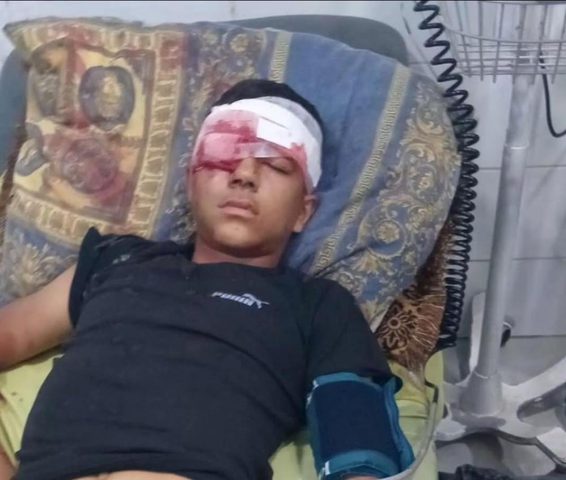 إصابة طفل بجروح خطيرة بقنبلة صوت أطلقها جنود الاحتلال صوب رأسه