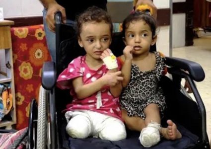 الصحة بغزة: 6000 حالة بتر خلال عامين وربع الضحايا أطفال