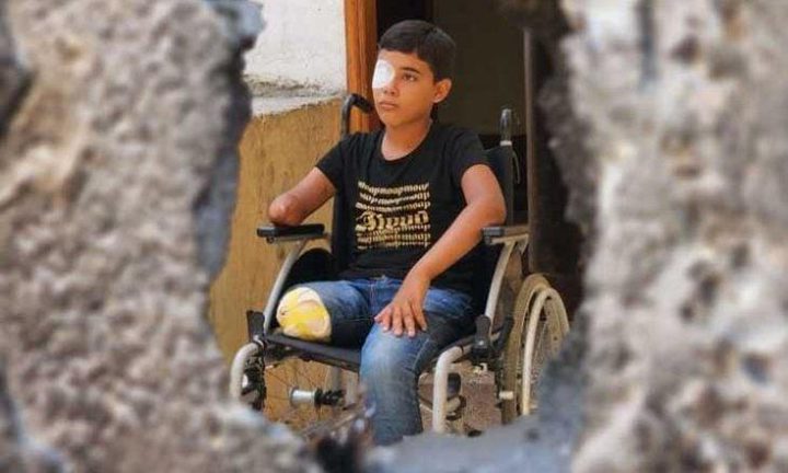 منظمة أمريكية تُحذّر: 6 آلاف مبتور في غزة يحتاجون إعادة تأهيل عاجل ودعم نفسي