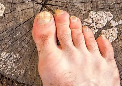 فطريات الأظافر.. عدوى شائعة تصيب القدمين وتزداد مع التقدم في العمر