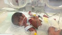 ارتفاع صادم في حالات الولادة المبكرة والتشوهات في غزة خلال 2025