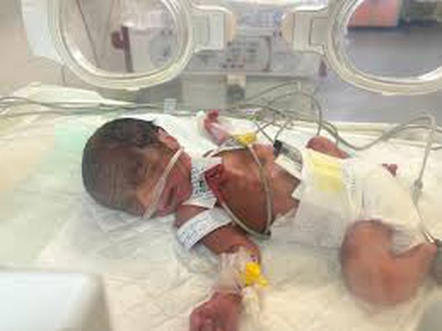 ارتفاع صادم في حالات الولادة المبكرة والتشوهات في غزة خلال 2025