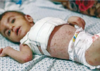 الأونروا تحذر من تفاقم الأمراض الجلدية في غزة