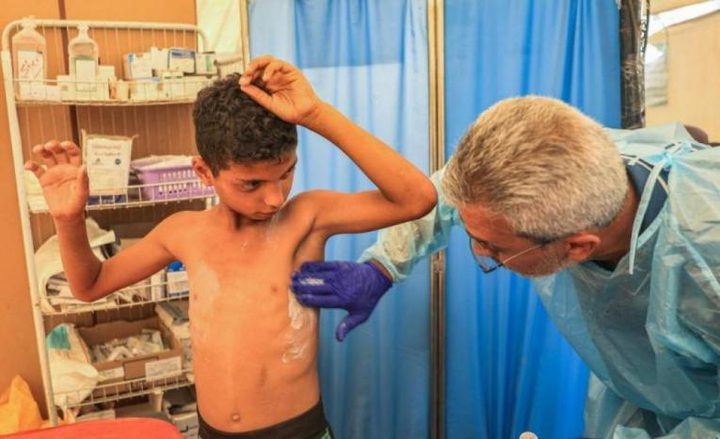 الأمم المتحدة تُحذر من تفشٍ واسع لـ "جدري الماء" في قطاع غزة
