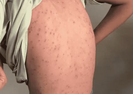نحو 58 ألف إصابة بجدري الماء في قطاع غزة منذ بداية العام